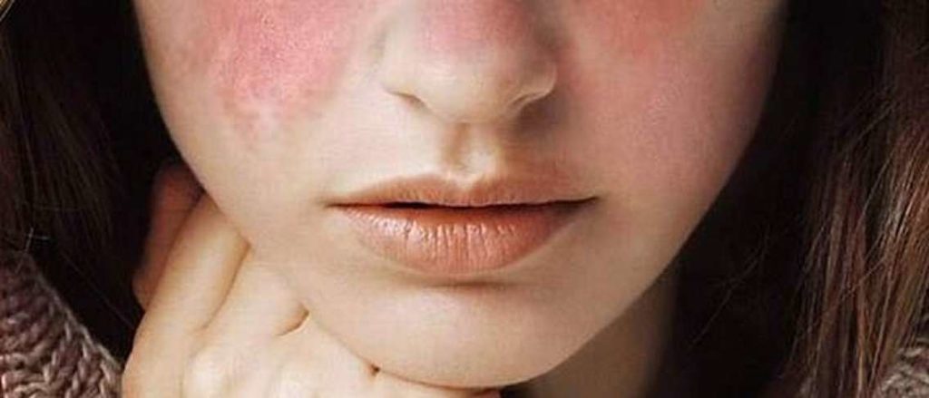 Artikel Kesehatan Mengenai Lupus